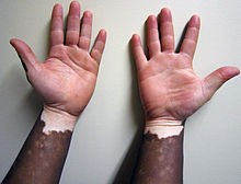 08-37-20-220px-Vitiligo1.JPG